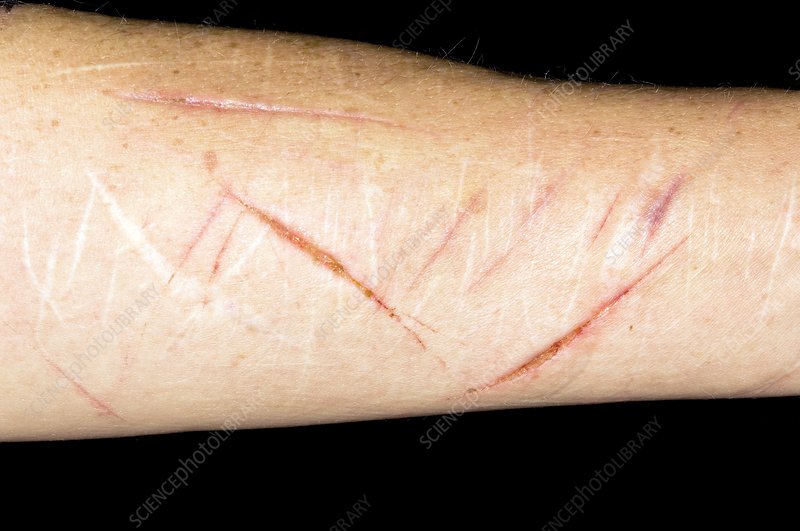 Self harm MODEL RELEASED Self harm scars on the arm of a 49 year old female with chronic depression PUB